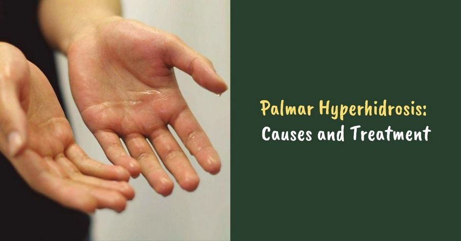 Palmar Hyperhidrosis: Causes and Treatment