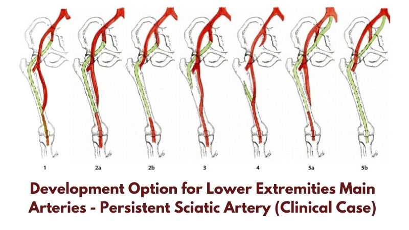 Development Option for Lower Extremities Main Arteries - Persistent Sciatic Artery (Clinical Case)