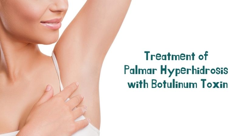 Treatment of Palmar Hyperhidrosis with Botulinum Toxin